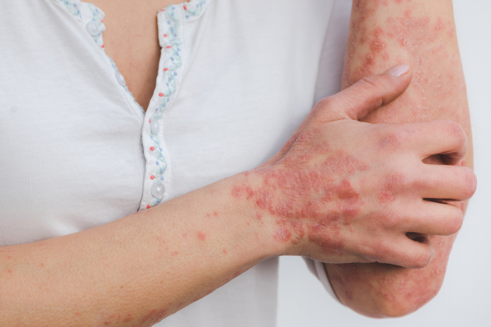 Psoríase pode ser confundida com o eczema, atrasar o tratamento e agravar os sintomas