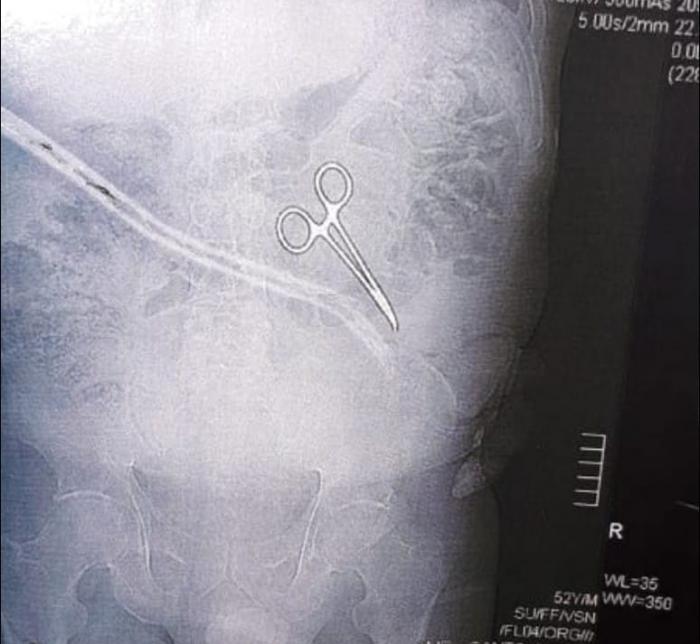 Médicos esquecem pinça cirúrgica dentro de barriga de paciente em hospital de Mauá