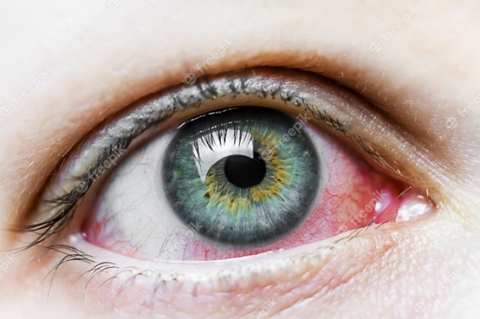 Oftalmologista alerta para os cuidados com a conjuntivite de verão